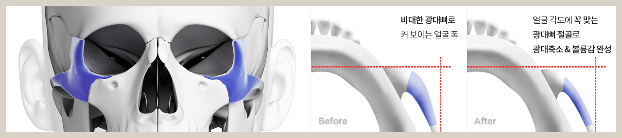 before 비대한 광대뼈로 커 보이는 얼굴 폭 , after 얼굴 각도에 꼭 맞는 광대뼈 절골로 광대축소 & 볼륨감 완성